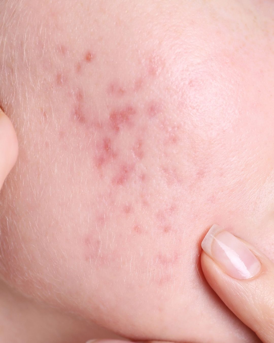 Cicatrici Acne