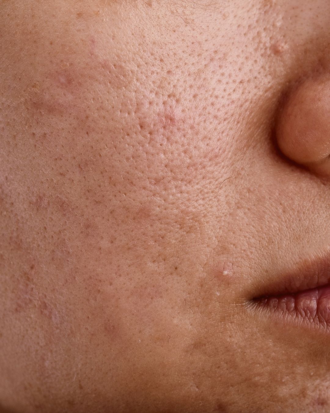 Acne & Imperfezioni